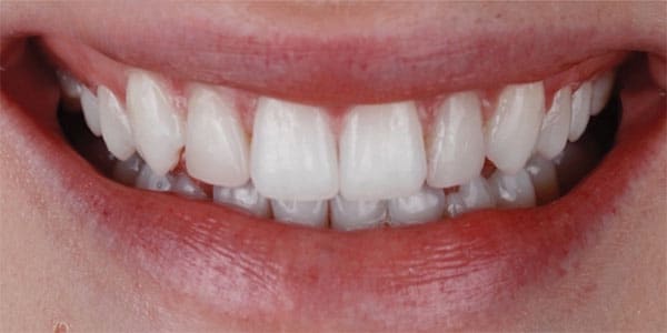 Réses felső és alsó frontfogak – kezelés után